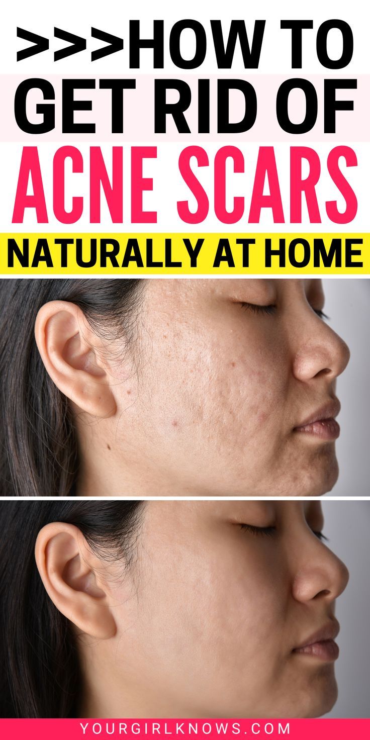 Are you struggling with acne scars? Don't worry, we have the solution. These tips will help clear up your skin and get rid of those pesky scars for good. So what are you waiting for? Start following these steps today! Home Remedies For Acne And Scars, Removing Acne Marks, Remove Acne Scarring, How To Remove Acne Scar Marks, Diy Acne Scar Remover, How To Clear Acne Scarring, How To Get Rid Of Scars From Acne, Remove Acne Marks On Face, How To Remove Acne Marks