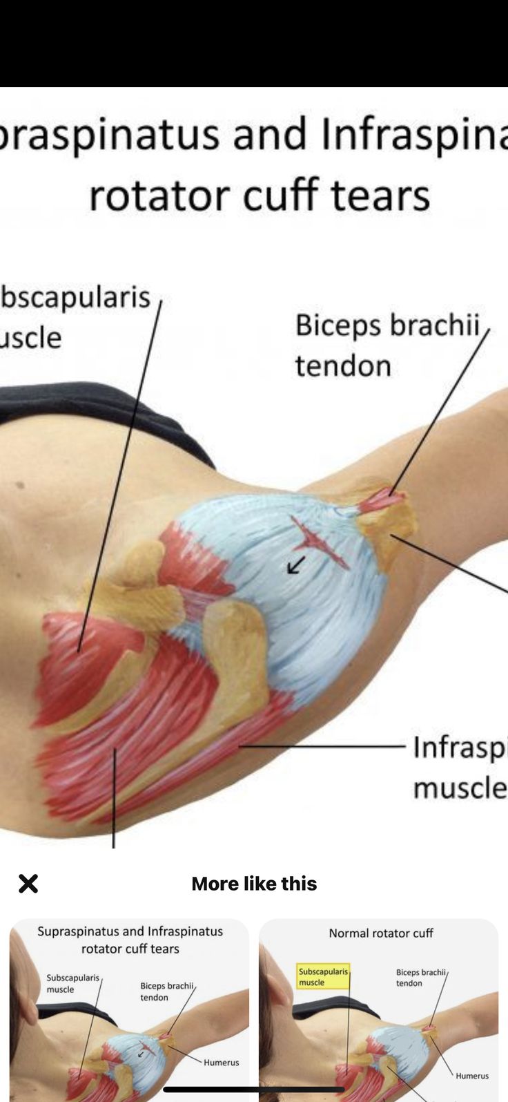 Biceps Brachii Muscle, Subscapularis Muscle, Infraspinatus Muscle, Rotator Cuff Pain, Punkty Spustowe, Shoulder Rehab Exercises, Shoulder Anatomy, Rotator Cuff Exercises, Rotator Cuff Surgery