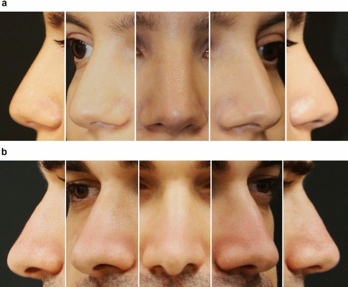 the stages of nose surgery are shown in four different pictures, each with an upper lip and lower lip