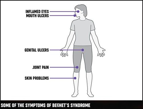 Behçet’s syndrome | Causes, symptoms, treatments Behcets Syndrome, Bad Headache, Loss Of Balance, Complementary Medicine, Alternative Therapies, Blood Test, Autoimmune Disease, Blood Vessels, Very Rare