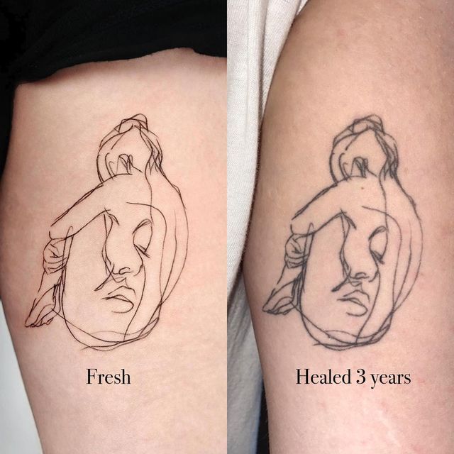 before and after images of tattoo removals on the thighs, from left to right