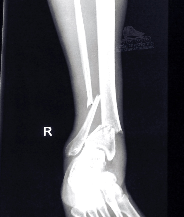 an x - ray shows the foot and ankle bones