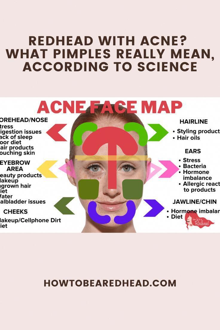 Did you know different types of acne are actually caused by different things and some need to be treated differently than others? Pimple Meaning, Cheek Acne, Closed Comedones, Skin Blackheads, Pimples On Forehead, Different Types Of Acne, Face Mapping Acne, Forehead Acne, Bad Acne