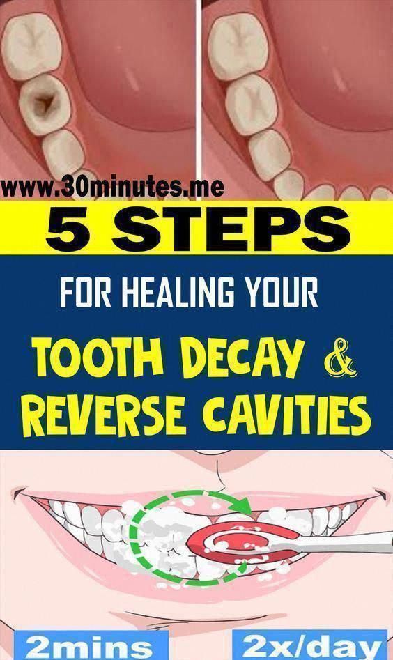 5 Steps For Healing Your Tooth decay And Reverse Cavities – New Healthy Life Now #HowToTakeCareOfOralHealth #WhatIsOralCareSystem #TakeCareOfOralHealth #OralCare #WhyIsOralHealthCareImportant #WhyIsOralCareSoImportant #WhatAreTheOralCareTips #WhatIsTheBestOralCareRoutine #WhatIsThePurposeOfOralCare #WhatIsPrimaryOralHealthCare #WhyIsOralCareImportantInHospitals Reverse Cavities, Dental Cavities, How To Prevent Cavities, Oral Care Routine, Receding Gums, Periodontal Disease, Oral Health Care, Tooth Decay, Oral Hygiene