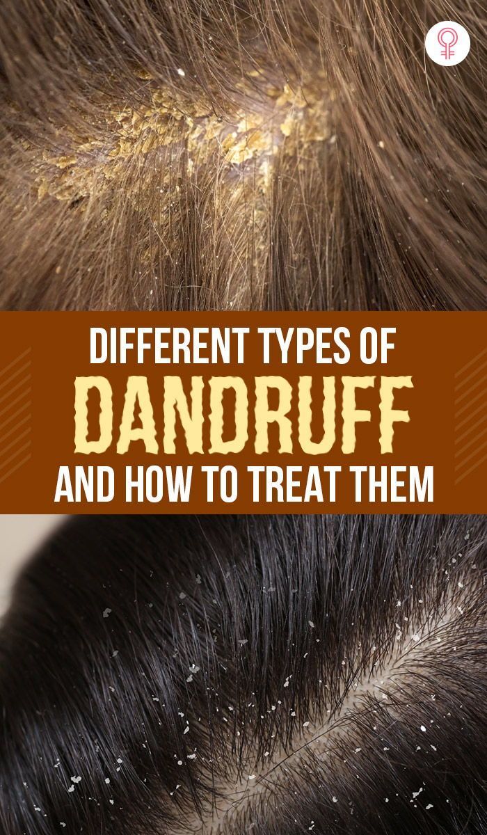 Different Types Of Dandruff And How To Treat Them: A variety of factors can cause dandruff. It can manifest itself in various ways, which must be understood before starting treatment. This article has explained the different types of dandruff and how to treat them. Keep reading. Oils For Dandruff, Dandruff Remedy, Getting Rid Of Dandruff, How To Grow Your Hair Faster, Natural Acne Remedies, Baking Soda Shampoo, How To Grow Nails, Flexible Dieting, Long Hai