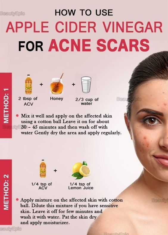 Apple Cider Vinegar On Face, Doterra Acne, Coffee Facial, Apple Vinegar, Apple Cider Benefits, Homemade Lotion, Acne Scar Removal, Home Remedies For Hair, Acne Remedies