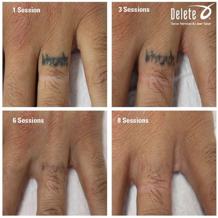 four pictures showing different stages of tattoo removals on someone's hand and fingers