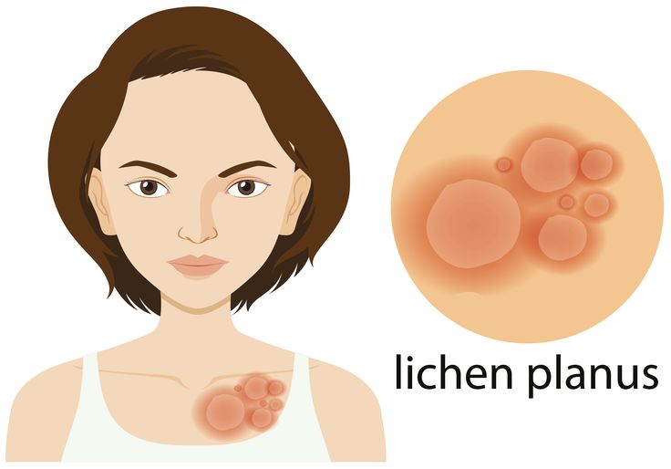 Lichen planus
skin health
dermatologist
skin care Lichen Planus, Skin Condition, Women Skin, Skin Disorders, Skin Diseases, Best Moisturizer, Medical Research, Light Therapy, Dermatology