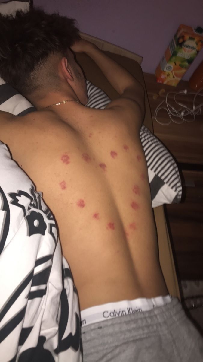 a man laying in bed with his back turned to the camera and it's red spots on his chest