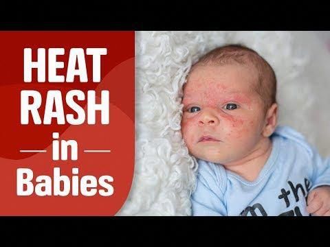 Are you worried about the red spot or small bumps on your baby's skin? This could be because of heat rash. Watch this video to learn about the symptoms, caus... Heat Rash Remedy For Babies, Skin Rash On Face, Heat Rash Remedy, Baby Heat Rash, Prickly Heat Rash, Baby Skin Rash, Rash On Face, Rashes Remedies, Prickly Heat