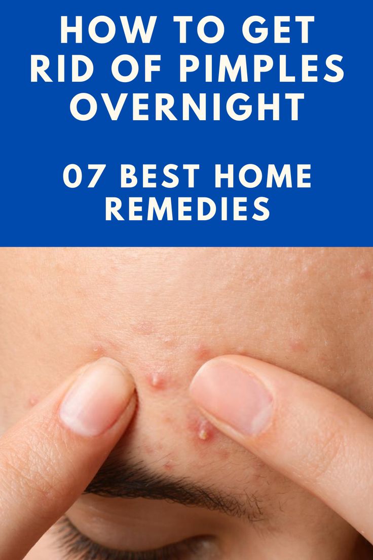 Face Pimples Remedies, Remove Pimples Overnight, Get Rid Of Pimples Overnight, Rid Of Pimples Overnight, Painful Pimple, Pimple Solution, Home Remedies For Pimples, Get Rid Of Pimples, Blind Pimple