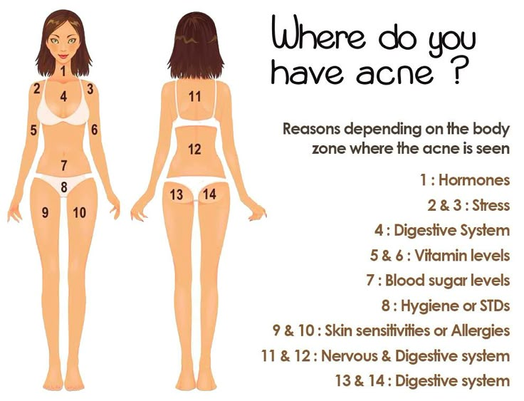 where do you have acne? Body Chart, Haut Routine, Remedies For Acne, Natural Acne Remedies, Severe Acne, Natural Acne, Body Acne, Get Rid Of Acne, Rid Of Acne