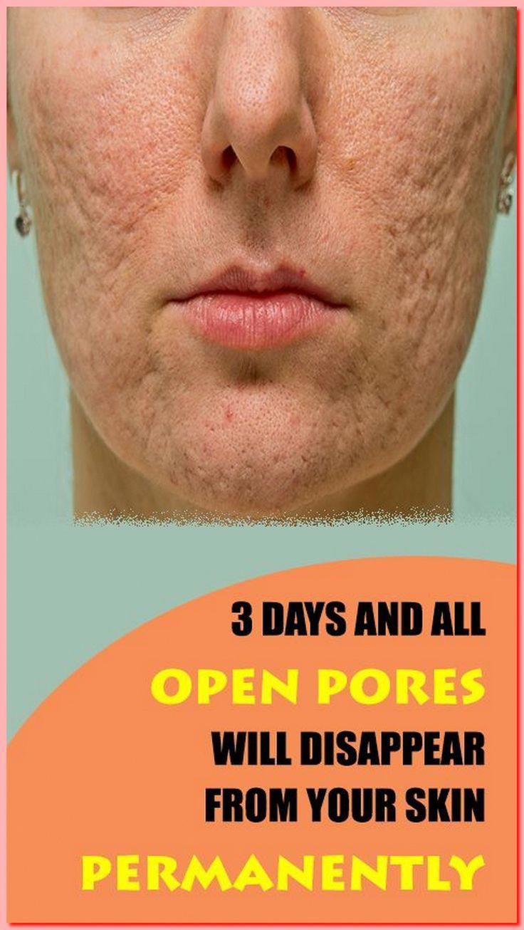 3 Days and All Open Pores Will  - Disappear From Your Skin Permanently! by falumbhomsynch falumbhomsynch | This newsletter was created with Smore, an online tool for creating beautiful newsletters for educators, nonprofits, businesses and more Lotion For Oily Skin, Natural Toner, Healthy Facts, Anti Wrinkle Skin Care, Open Pores, Body Coach, Healthy Advice, Baking Soda Shampoo, Enlarged Pores