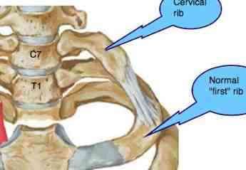 Cervical ribs are usually small and of no clinical significance but occasionally they cause a Thoracic Outlet Syndrome. Cervical Rib, Rib Anatomy, Thoracic Outlet, Rib Pain, Sore Shoulder, First Rib, Ulnar Nerve, Chronic Lower Back Pain, Middle Back Pain