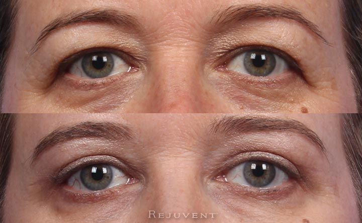 Upper Eyelid Surgery Close up no more hooded eyes Belfaroplasty Eyes, Hooded Eye Surgery, Eye Bag Surgery, Crepey Eyelids, Plastic Surgery Quotes, Surgery Quotes, Drooping Eyelids, Hooded Eyelids, Upper Eyelid