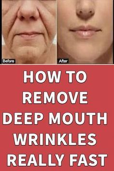 Cheek Wrinkles, Face Wrinkles Remedies, Wrinkles Remedies Face, Mouth Wrinkles, Wrinkle Remedies, Wrinkle Free Skin, Lip Wrinkles, Skin Care Wrinkles, Face Wrinkles