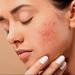 How to get rid of acne | Skincare tips.