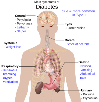 Viktiga symptom vid diabetes, engelsk text