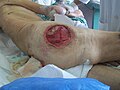 Article: Pressure ulcer