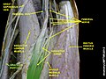 Gracilis muscle