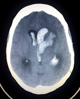 CT scan van een spontaan intracerebraal hematoom