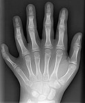 X-ray from a ten year old male's left hand, posterior-anterior projection. Drgnu23, subsequently altered by Grendelkhan, Raul654, and Solipsist, CC-BY-SA 3.0 unported