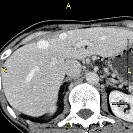 Axial CT image showing anomalous hepatic veins coursing on the liver's subcapsular anterior surface[72]