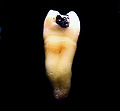 This picture, shows a restored premolar