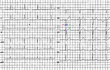 Normálny EKG