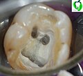 Lower molar with four root canals