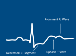 Het ECG-patroon bij hypokaliëmie