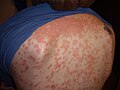 Article: Guttate psoriasis; template image