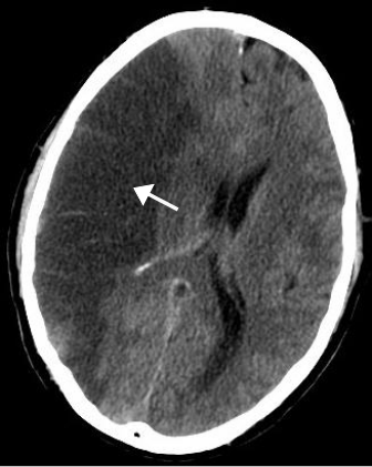 Brain infarct