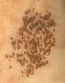 Nevus spilus