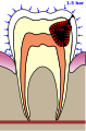 Pressure on a damaged tooth