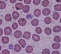 Article: Giant platelet disorder ?