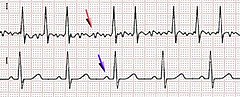 Afib ecg