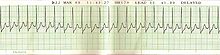 EKG supraventrikulárnej tachykardie