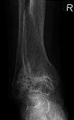 Frontal X-ray scan of ankle with secondary osteoarthritis