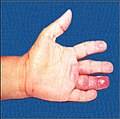 Cutaneous lesions of leprosy in hand