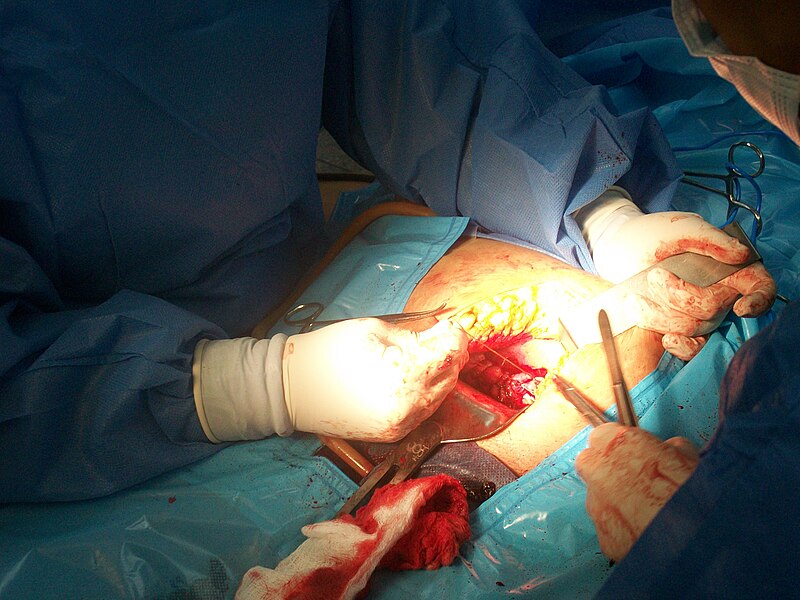 File:Suturing uterus.JPG