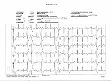 Ekg abnormal bionerd.jpg