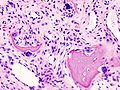 Histopathology of osteoarthrosis of a knee joint in an elderly female.