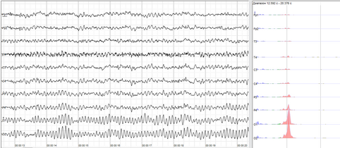 Human EEG with prominent resting state activity – alpha-rhythm. Left: EEG traces (horizontal – time in seconds; vertical – amplitudes, scale 100 μV). Right: power spectra of shown signals (vertical lines – 10 and 20 Hz, scale is linear). Alpha-rhythm consists of sinusoidal-like waves with frequencies in 8–12 Hz range (11 Hz in this case) more prominent in posterior sites. Alpha range is red at power spectrum graph.