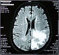 Article: Edema cerebral