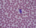 Article: Reactive lymphocyte