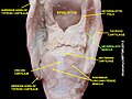 عضلة طرجهالية (بالإنجليزية: Aryepiglotic muscle)‏.