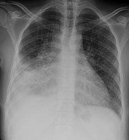 Thoraxfoto van miliaire tuberculose met lymfekliervergroting in het mediastinum en consolidaties rechtsonderin (voor de kijker links)