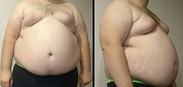 A front and side view of a "Class III male living with obesity" torso. Stretch marks of the skin are visible along with gynecomastia.