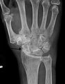 Severe osteoarthritis and osteopenia of the carpal joint and 1st carpometacarpel joint.